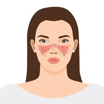 Understanding Lupus: Symptoms, Causes, and Diagnosis